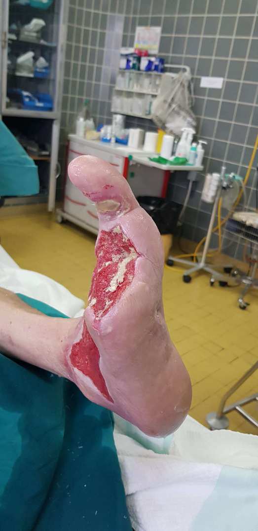 Prekrvavitev stopala je dovoljšnja, da omogoči dobro celjenje rane